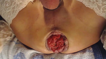 nal prolapse close up